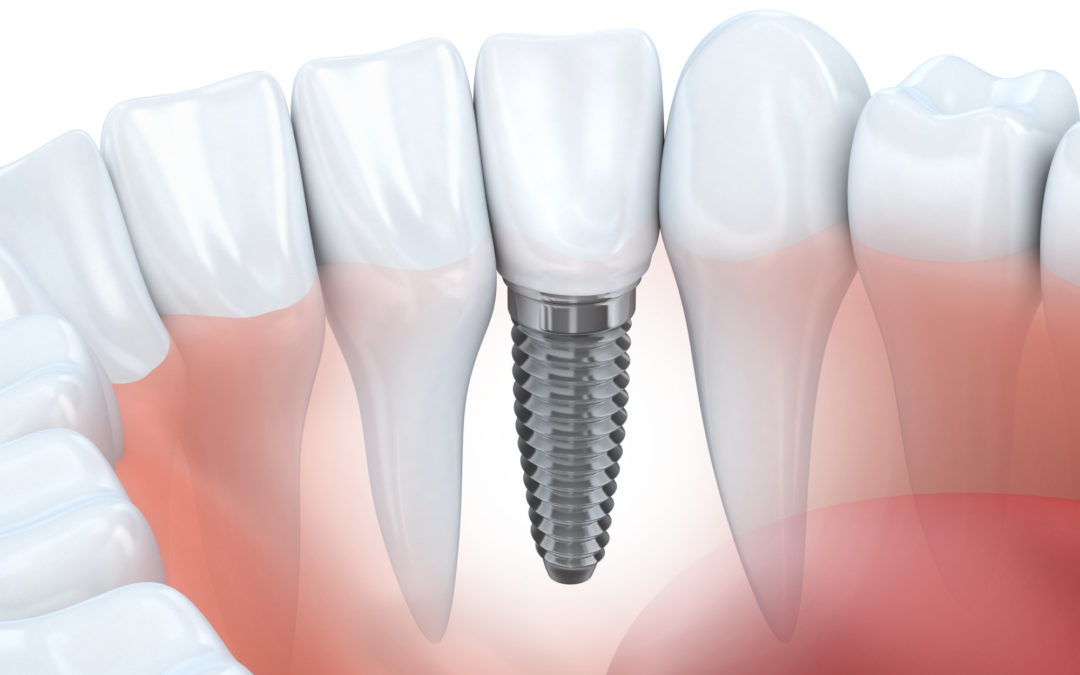root canal vs implant