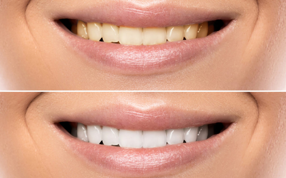 What is a Cosmetic Dentist and What Do They Do?